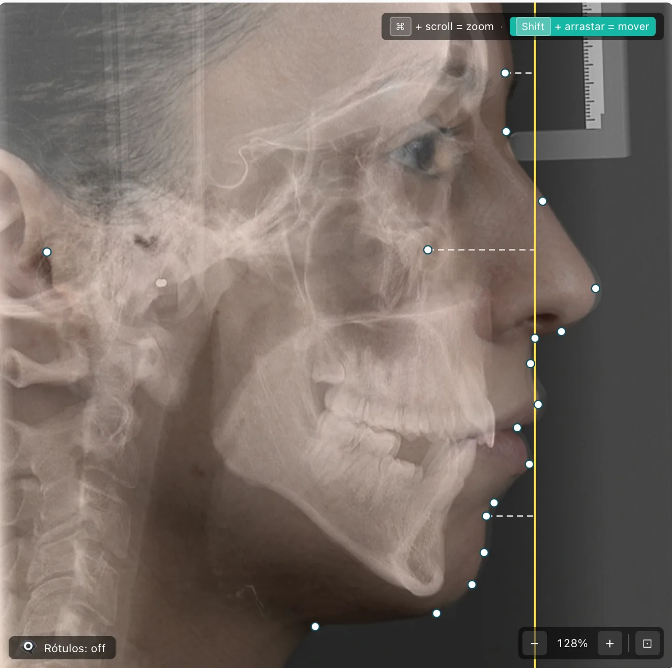 Telerradiografia lateral sobreposta sobre foto de perfil no FacePlan, com pontos cefalométricos marcados
